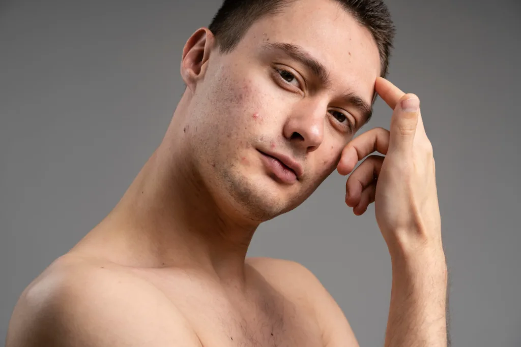 Objevte hlavní příčiny akné v dospělosti a seznamte se s účinnými metodami jejich řešení. Naučte se, jak pečovat o problematickou pleť a zbavit se akné jednou provždy.